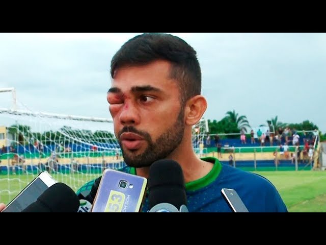 Jogador leva CHUTE no ROSTO e sai desfigurado