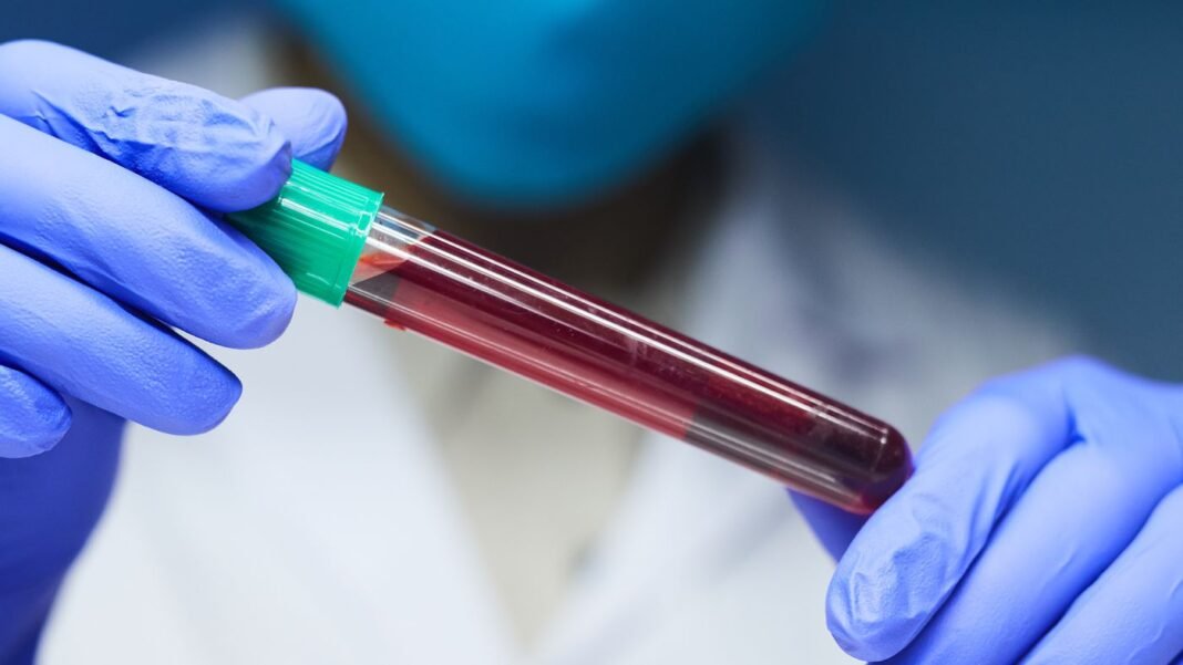 Cientistas criam novo exame de sangue para detectar câncer de próstata
