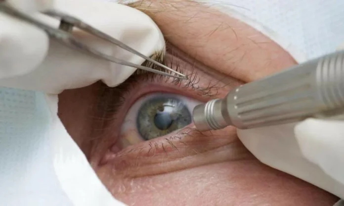 O Caso da Cirurgia de Catarata em Taquaritinga e as Sequelas nos Pacientes
