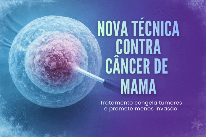 Nova técnica congela tumores de mama por crioablação Tumor de mama sendo congelado durante procedimento de crioablação em novo tratamento testado no Brasil.