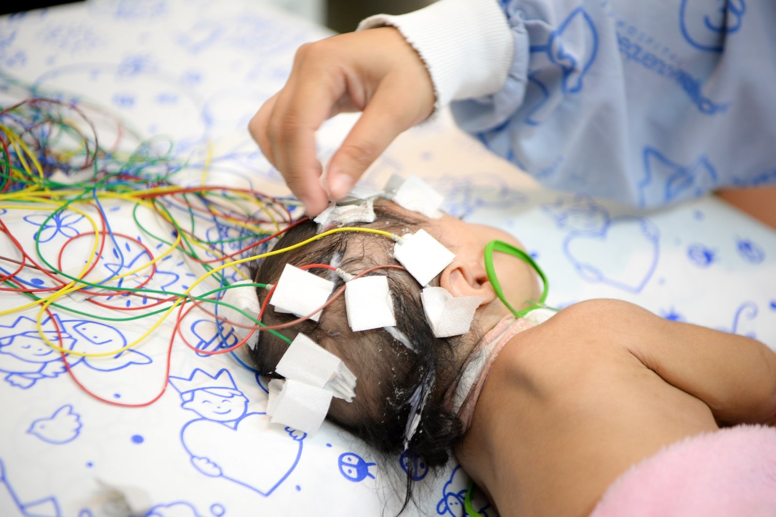 Criança com epilepsia infantil realizando exame com sensores na cabeça durante tratamento com novo remédio