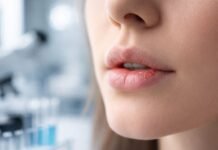 Cientistas descobrem como bloquear o vírus Epstein-Barr vírus Epstein-Barr com lesão labial em estudo científico sobre bloqueio do vírus