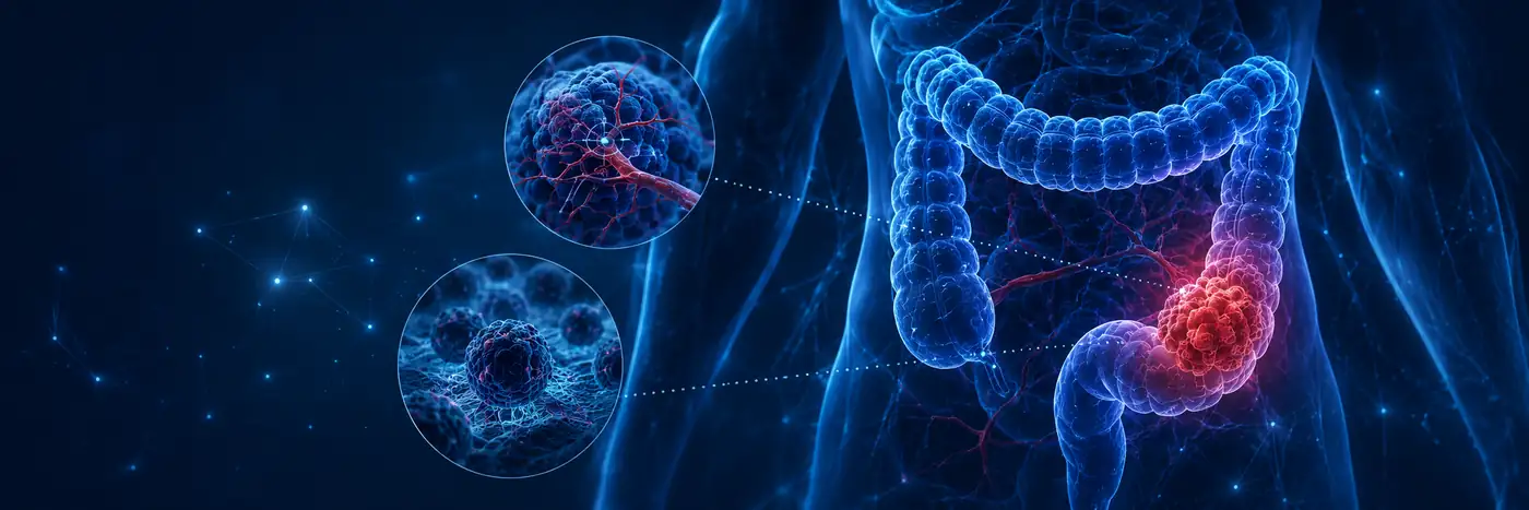 tratamento para câncer colorretal representado por tumor e vascularização do cólon